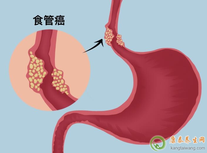 食道癌会传染给家人吗